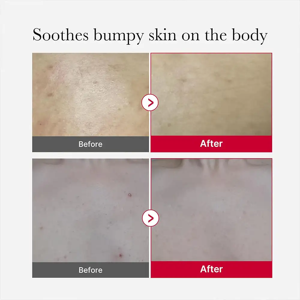 اسپری لایه بردار و ضد جوش بدن مدی کیوب اصل مدل Medicube Red Acne Body Peeling Shot مناسب کاهش جوش بدن، زبری پوست، استرابری اسکین، پاکسازی منافذ و صاف شدن پوست بدن