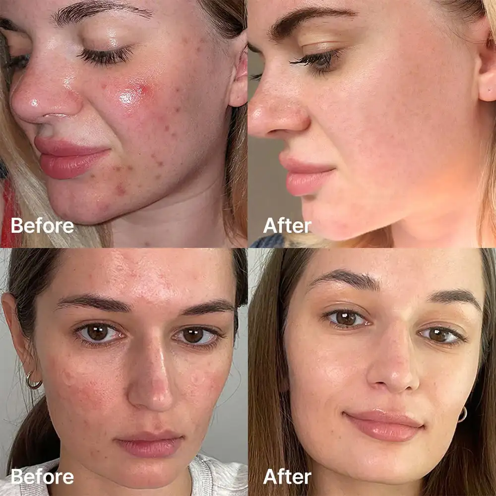 سرم پیلینگ سوکسینیک اسید مدی کیوب اصل مدل Medicube Red Acne Succinic Acid Peel، لایه‌بردار شستنی 21 درصد مناسب پوست جوش‌دار، منافذ، چربی اضافه، جوش سرسیاه و بافت ناهموار
