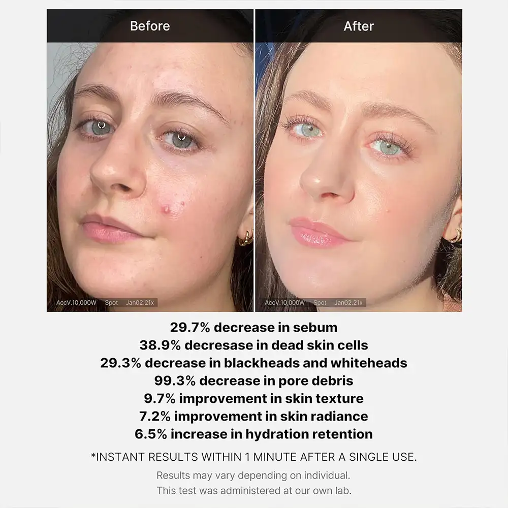 سرم پیلینگ سوکسینیک اسید مدی کیوب اصل مدل Medicube Red Acne Succinic Acid Peel، لایه‌بردار شستنی 21 درصد مناسب پوست جوش‌دار، منافذ، چربی اضافه، جوش سرسیاه و بافت ناهموار