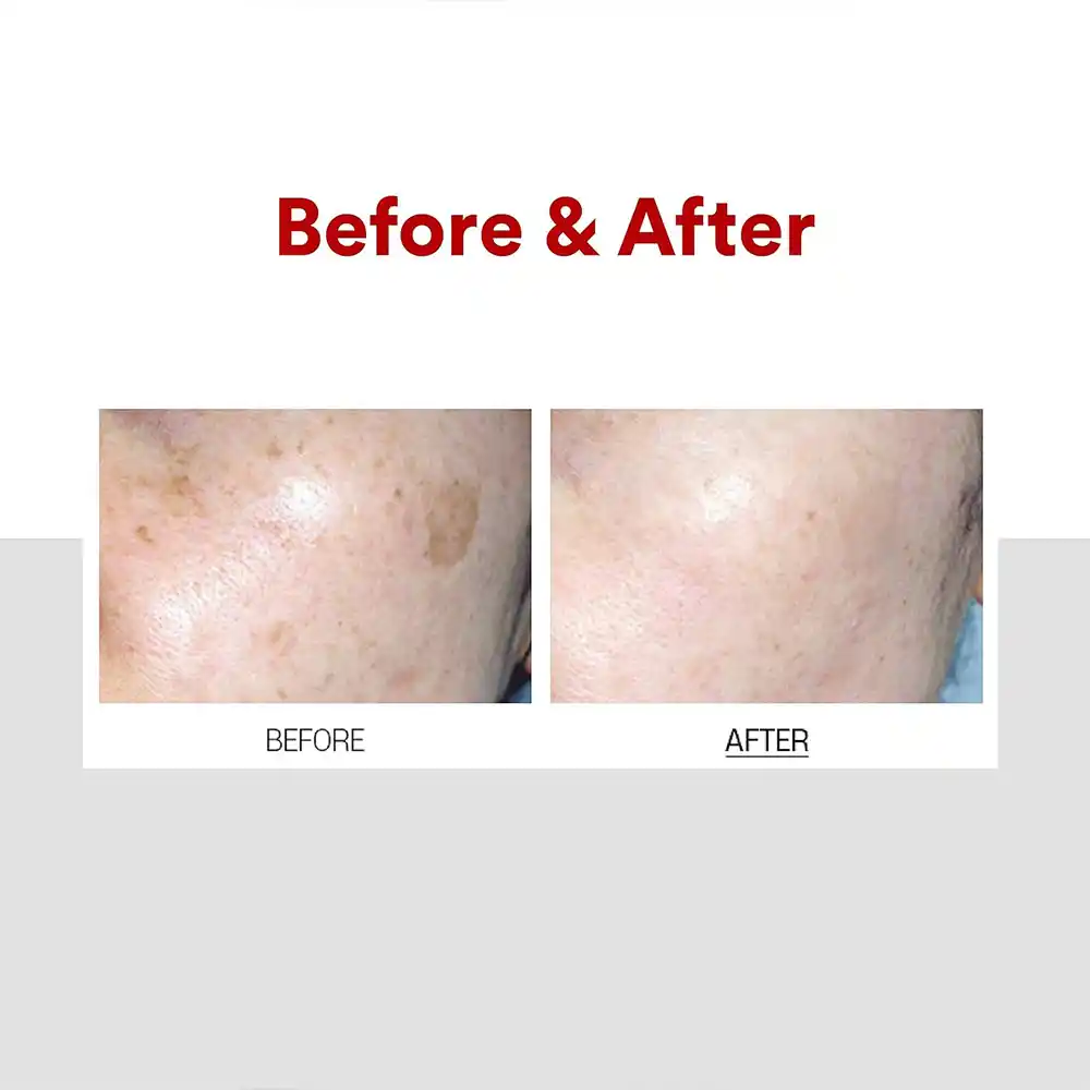 کرم ضد لک و روشن کننده ملانون ایکس مدی پیل Medi Peel Melanon X Cream