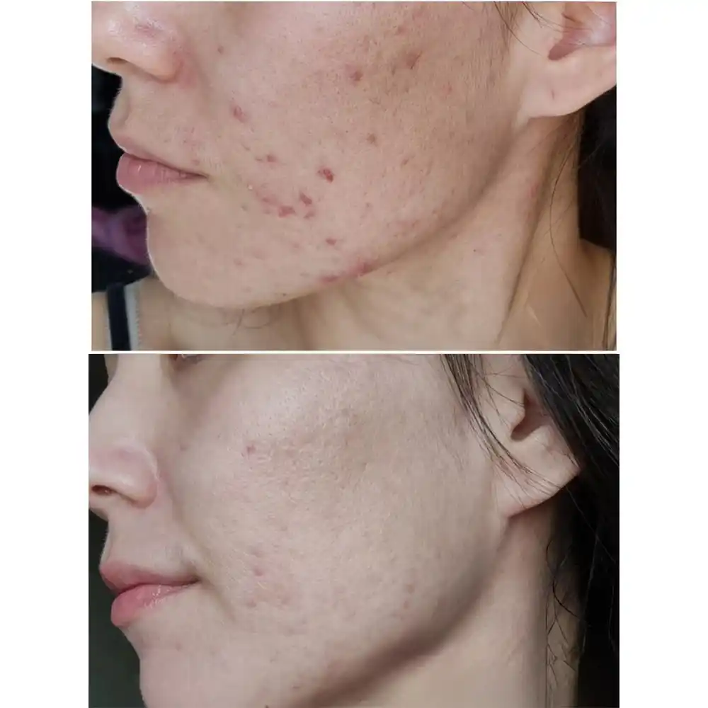 ژل شستشوی صورت سبیوم بایودرما Bioderma Sebium Gel Moussant برای پوست چرب و مختلط مستعد آکنه