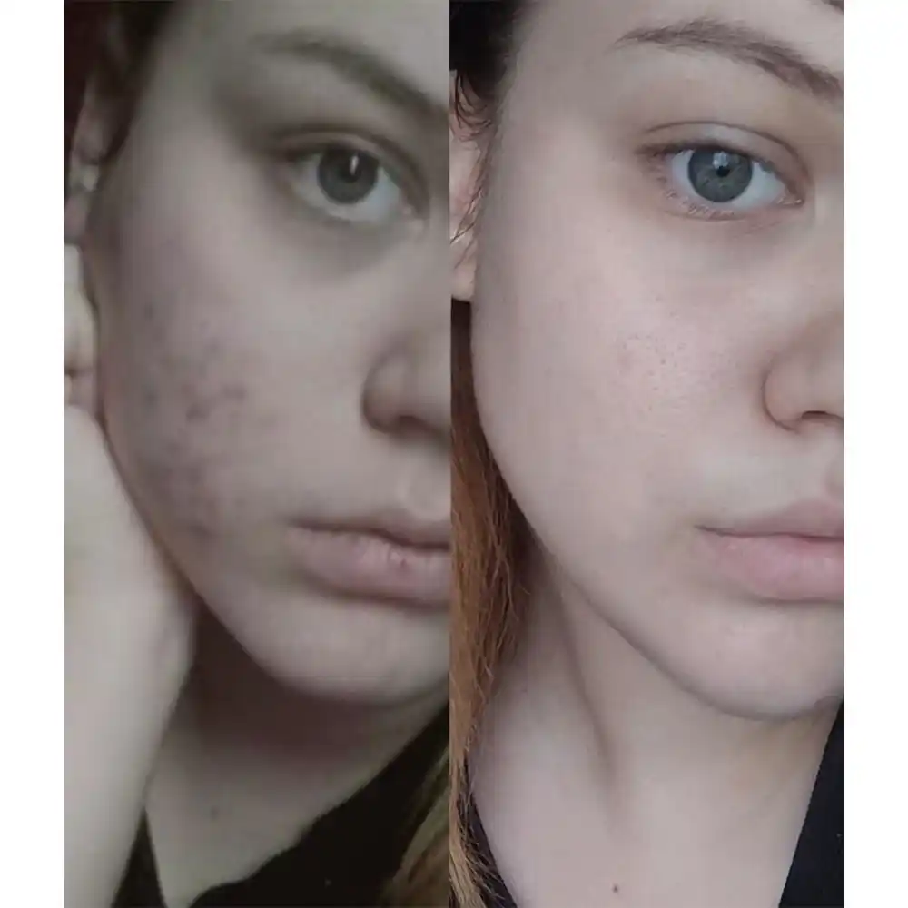 ژل شستشوی صورت سبیوم بایودرما Bioderma Sebium Gel Moussant برای پوست چرب و مختلط مستعد آکنه