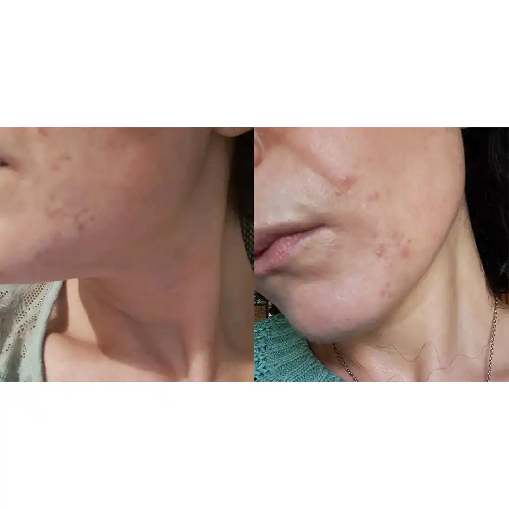 ژل ضد جوش دیفرین آداپالن Differin Adapalene Gel 0.1% آمریکا درمان آکنه و لایه‌برداری رتینوئید