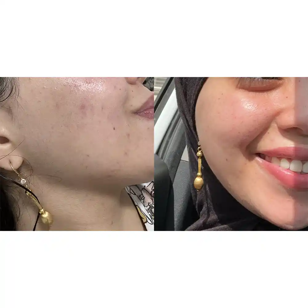 تونر ضد جوش و آبرسان 30 روزه میراکل سام بای می Some By Mi AHA BHA PHA 30 Days Miracle Toner 150ml
