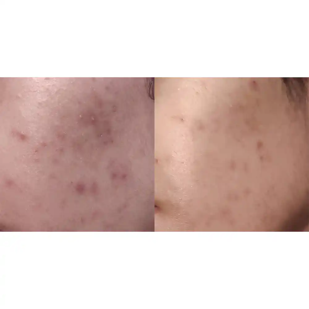 تونر ضد جوش و آبرسان 30 روزه میراکل سام بای می Some By Mi AHA BHA PHA 30 Days Miracle Toner 150ml