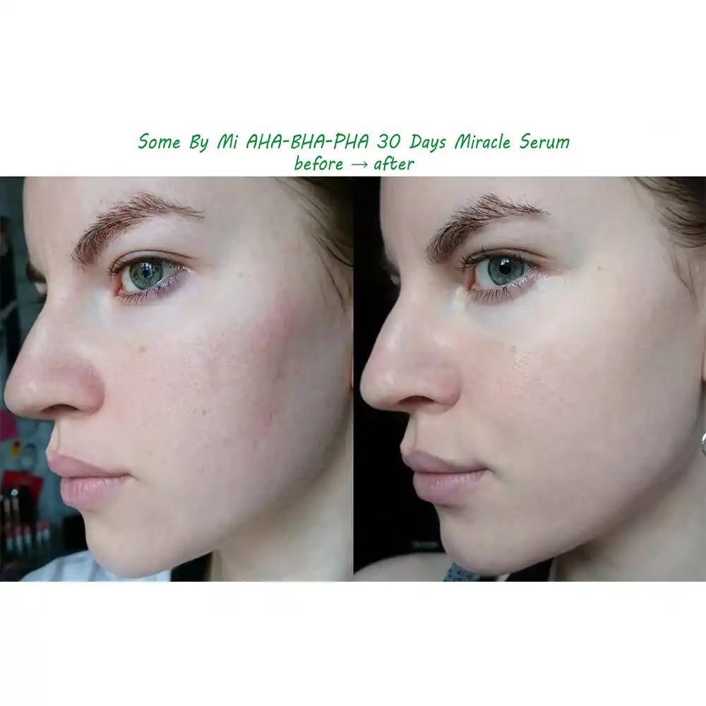 سرم ضد جوش و آبرسان 30 روزه میراکل سام بای می SOME BY MI AHA BHA PHA 30 Days Miracle Serum 50ml