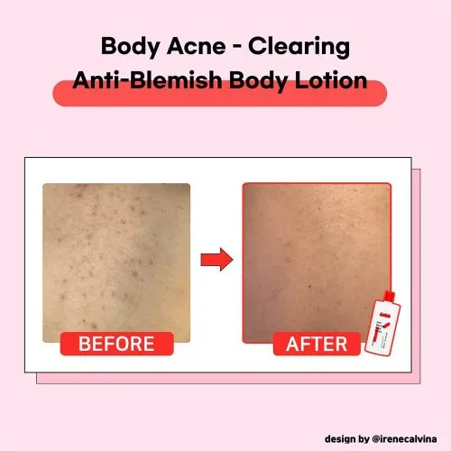 وسیون بدن ضد لک و روشن کننده تیام TIAM Anti Blemish Body Lotion