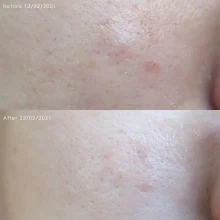 آمپول آرتیچوک ضد جوش و تسکین دهنده اکسیس وای