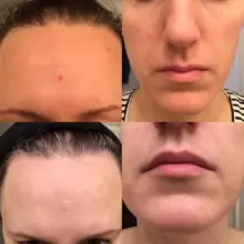 ژل ضد جوش دیفرین آداپالن Differin Adapalene Gel 0.1% آمریکا درمان آکنه و لایه‌برداری رتینوئید