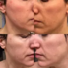ژل ضد جوش دیفرین آداپالن Differin Adapalene Gel 0.1% آمریکا درمان آکنه و لایه‌برداری رتینوئید